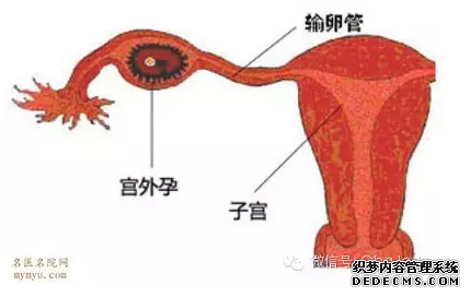 马鞍山腹痛、不规则阴道出血：宫外孕的隐身术